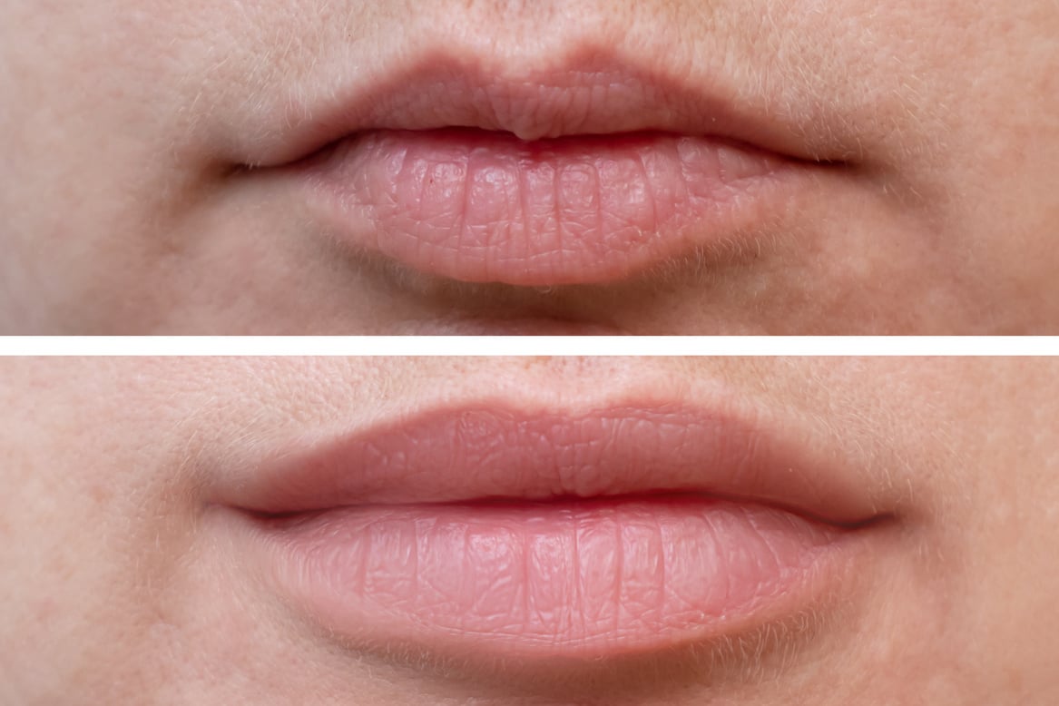 Before-and-after results of Vitallur® dermal filler treatment for facial enhancement.