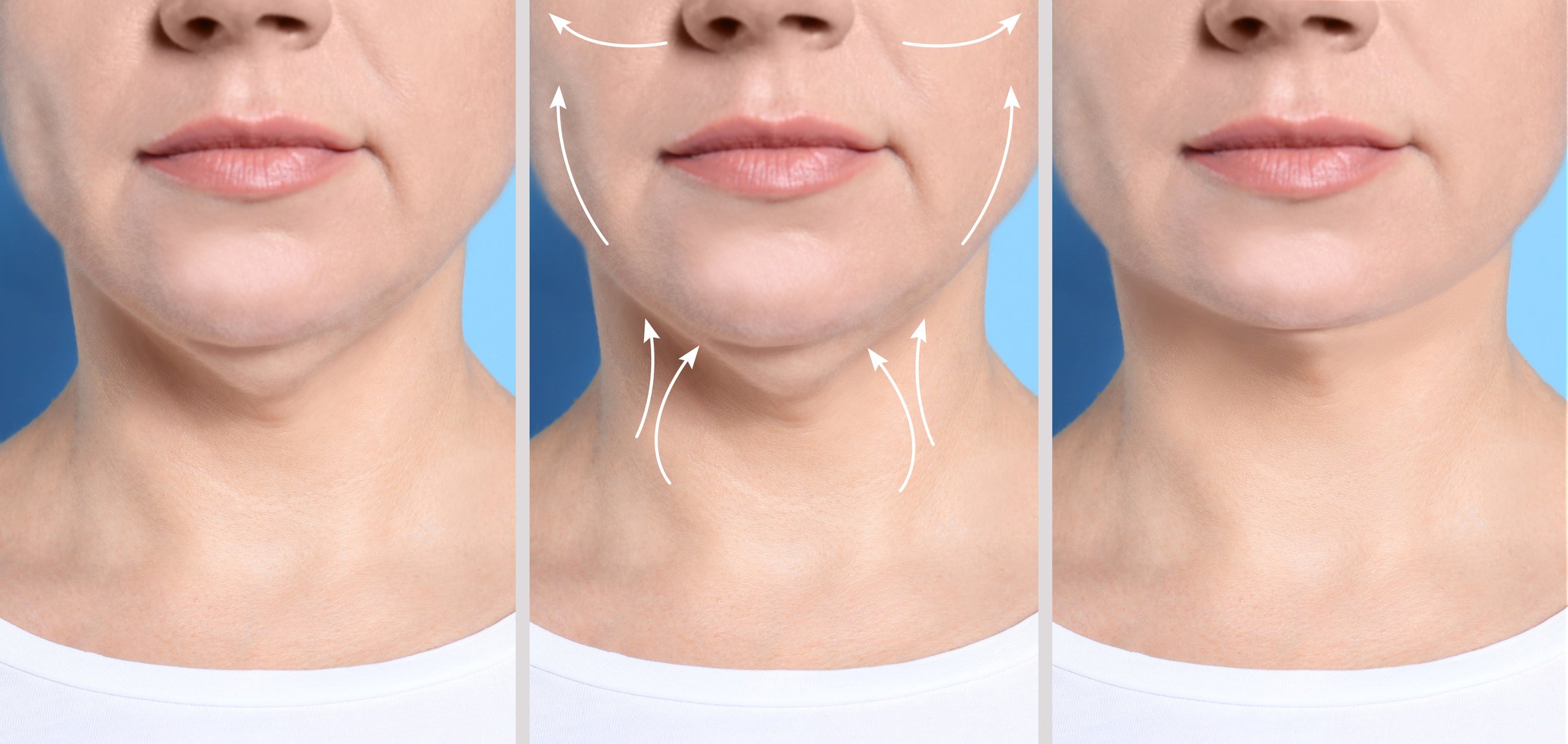 Before-and-after results of Vitallur® dermal filler treatment for facial enhancement.